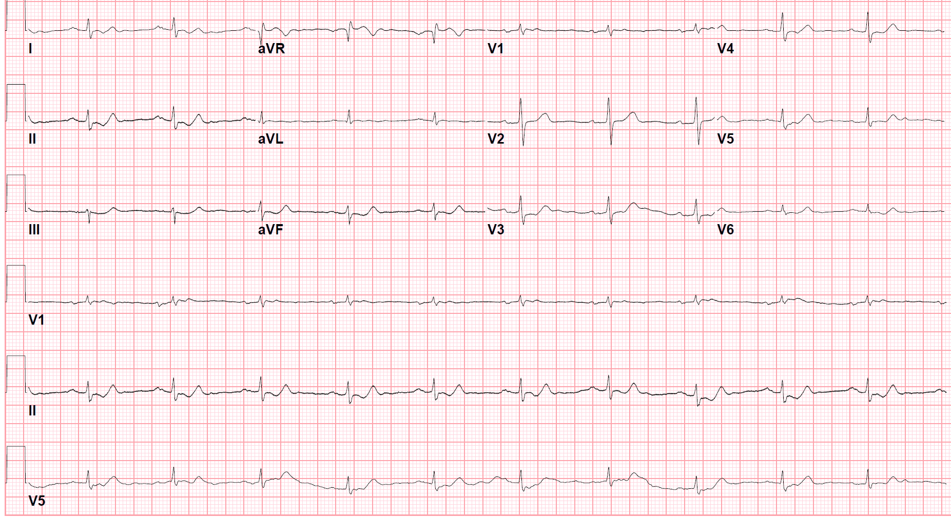 ed ecg #1