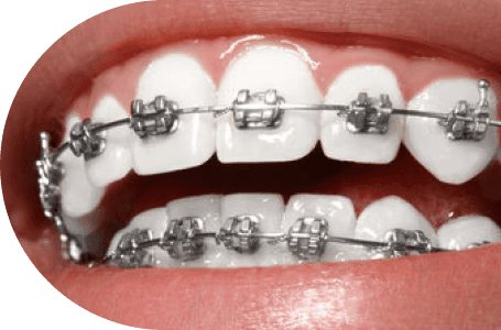 正畸协会认证牙医，AiCare Orthodontics，位于加州橙县，芳泉谷，尔湾，为全年龄段提供正畸服务