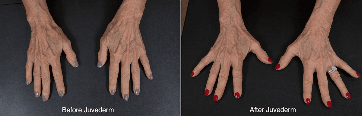 How Long Does Hand Filler Last?