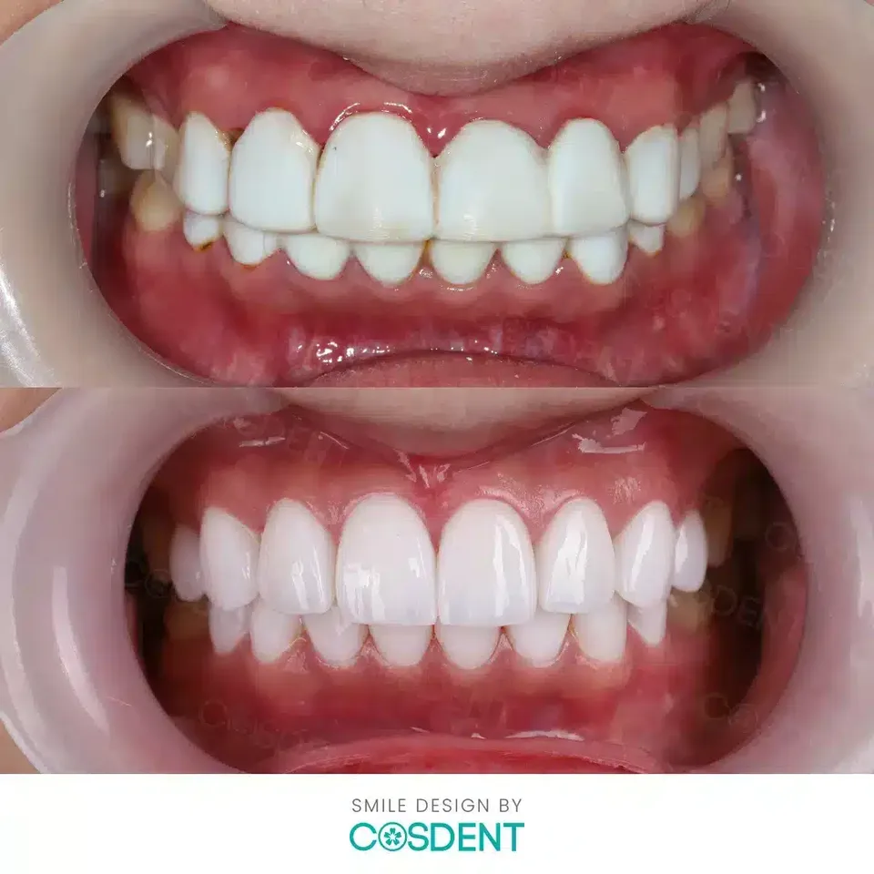 Before and after gum contouring and smile design transformation at COSDENT Bangkok