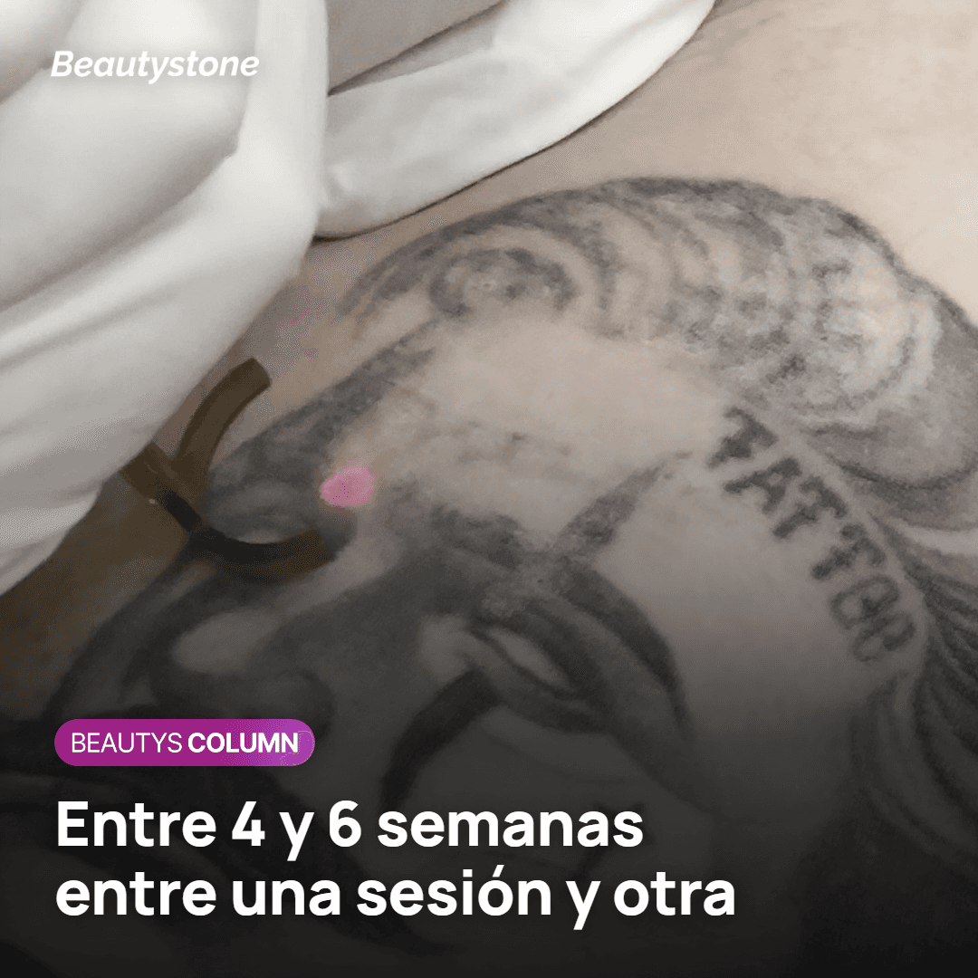 Intervalo recomendado entre sesiones de PicoWay para eliminar un tatuaje