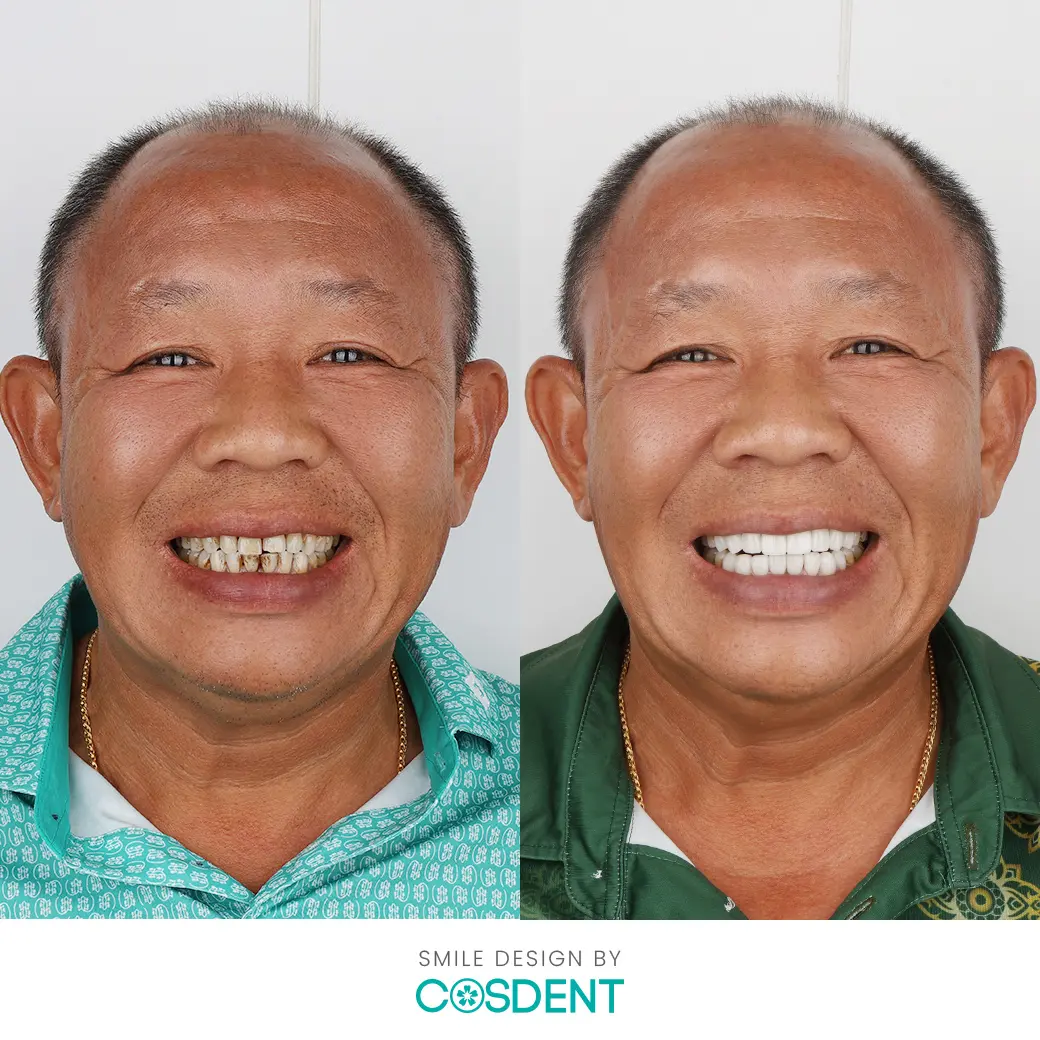 อิทธิกร กำธรกิจตระกูล (โก้) เคสทำวีเนียร์ หมอวรรณ cosdent