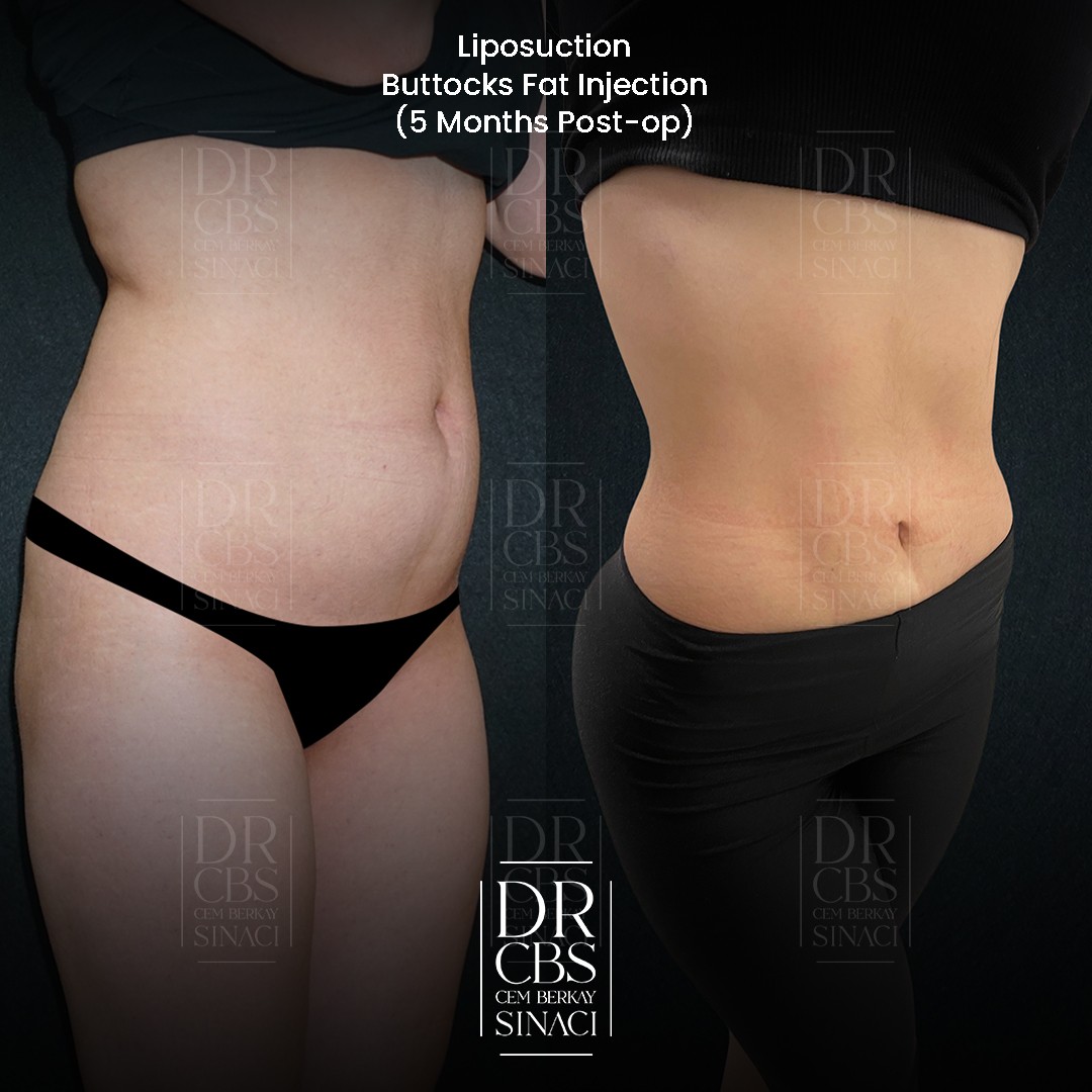 tummy vaser liposuction and laser skin tightening before after 5 months post-op