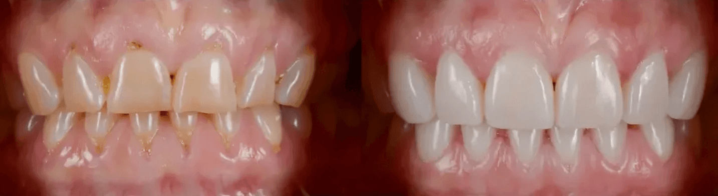 porcelain veneers near me
