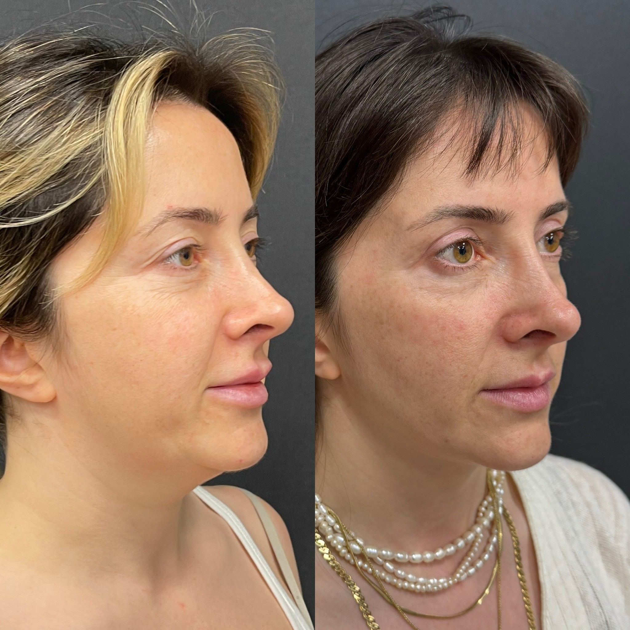 turkey neck deformity chin laser liposuction before after right oblique view