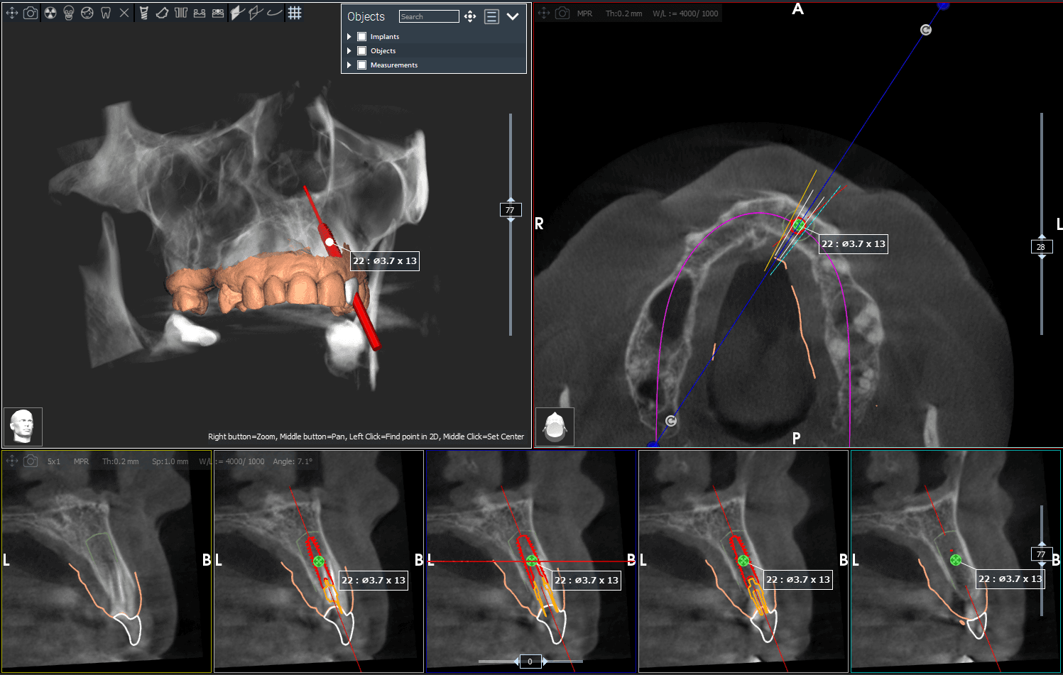 Een CT scan met implantologische planning in Realguide