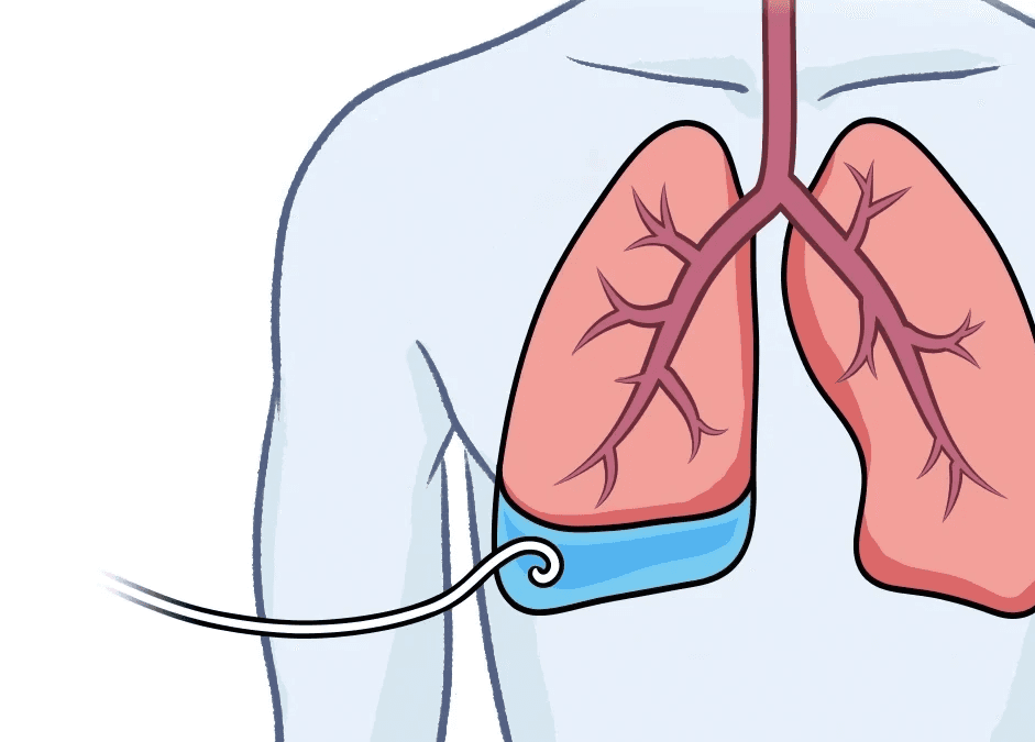 케모포트 일러스트