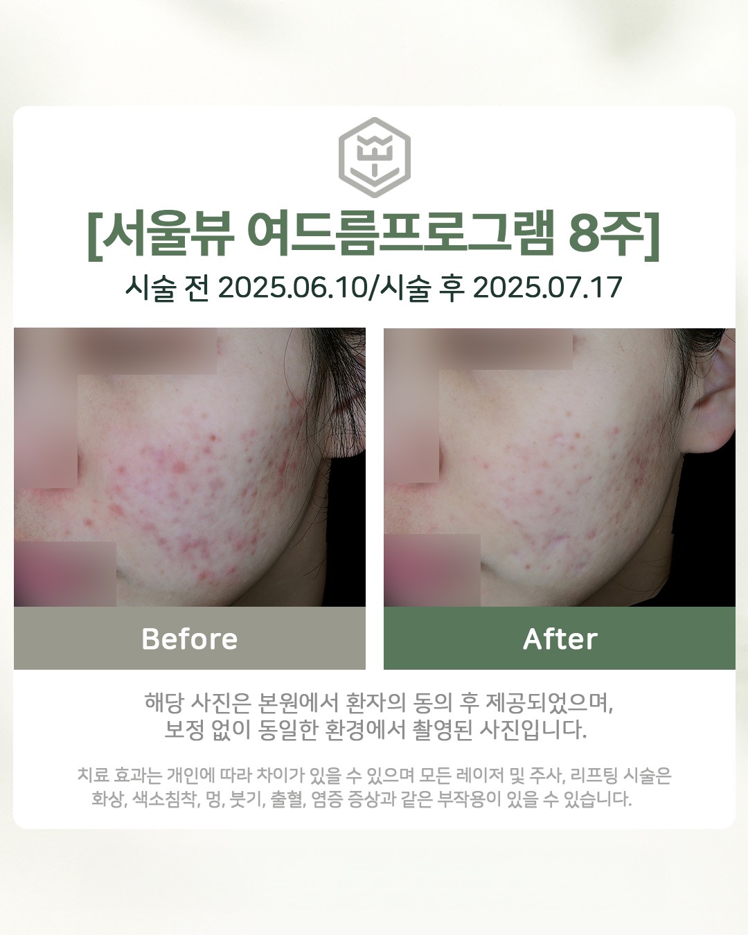 여드름프로그램 8주