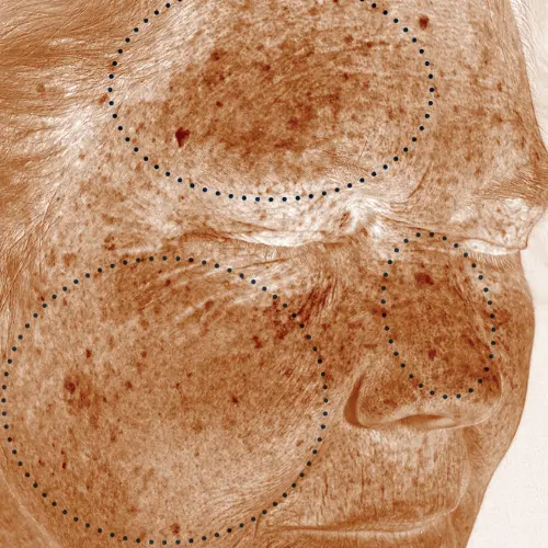 Before pigmentation discolouration treatment at The Vancouver Aesthetician — skin analysis revealing significant discolouration at both dermal and surface pigmentation levels