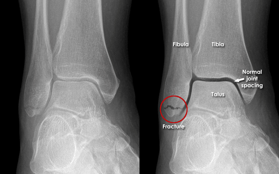 Ankle Fracture x-ray