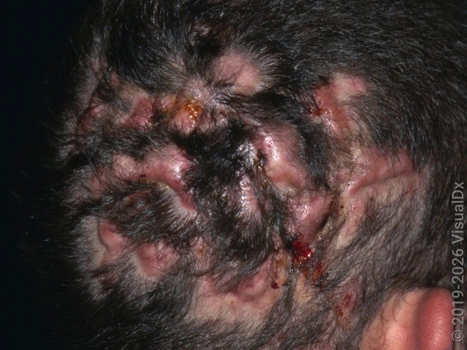 Dissecting Cellulitis of the Scalp — image from NorCal Hair Doctor™'s existing website