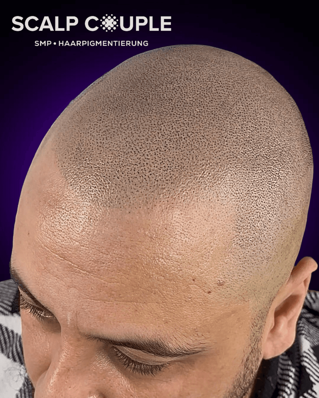 Haarpigmentierung Männer Vorher Nachher – SMP Ergebnis | Scalp Couple