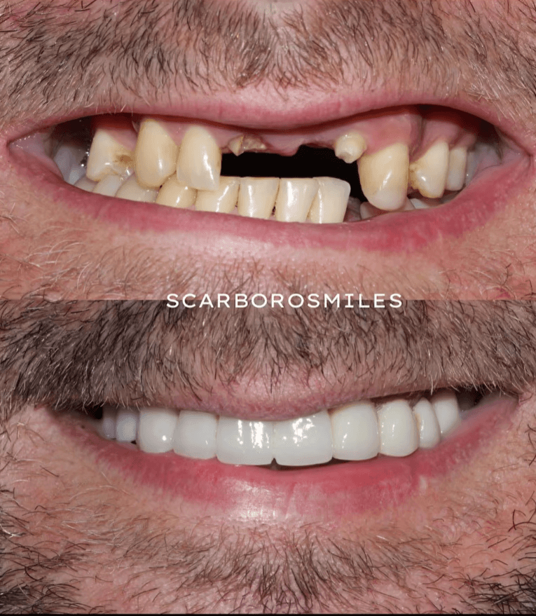 Before and After Bridge Repair at ScarboroSmiles Dental Clinic in Scarborough, ON | Best dentist in Scarborough.