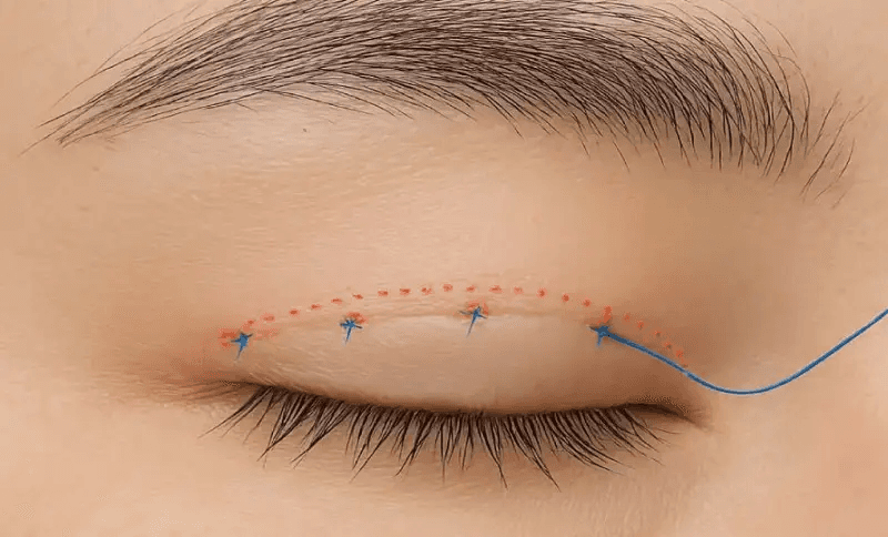 Cần chăm sóc cẩn thận để nếp mí nhấn được tự nhiên 