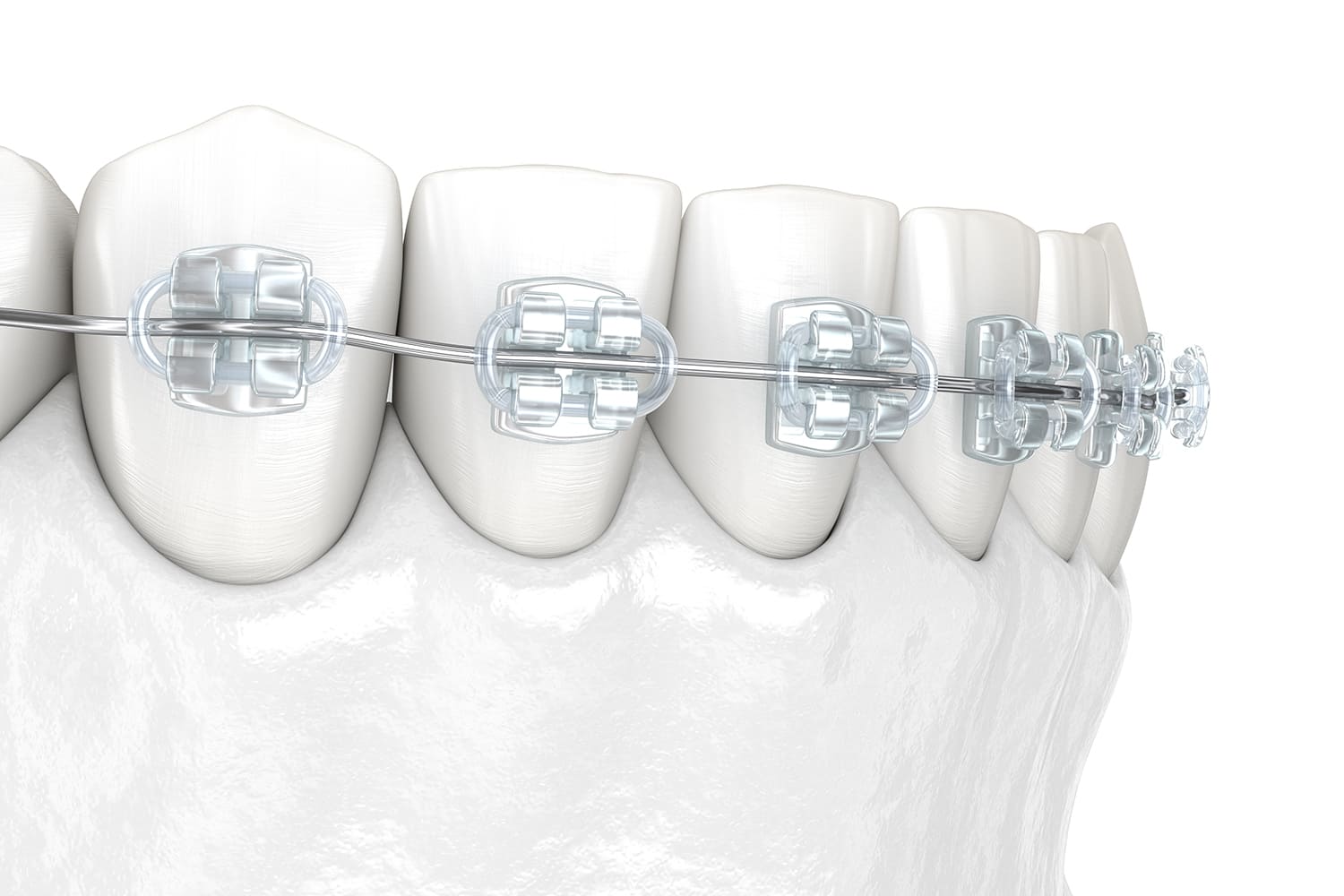 マウスピース矯正