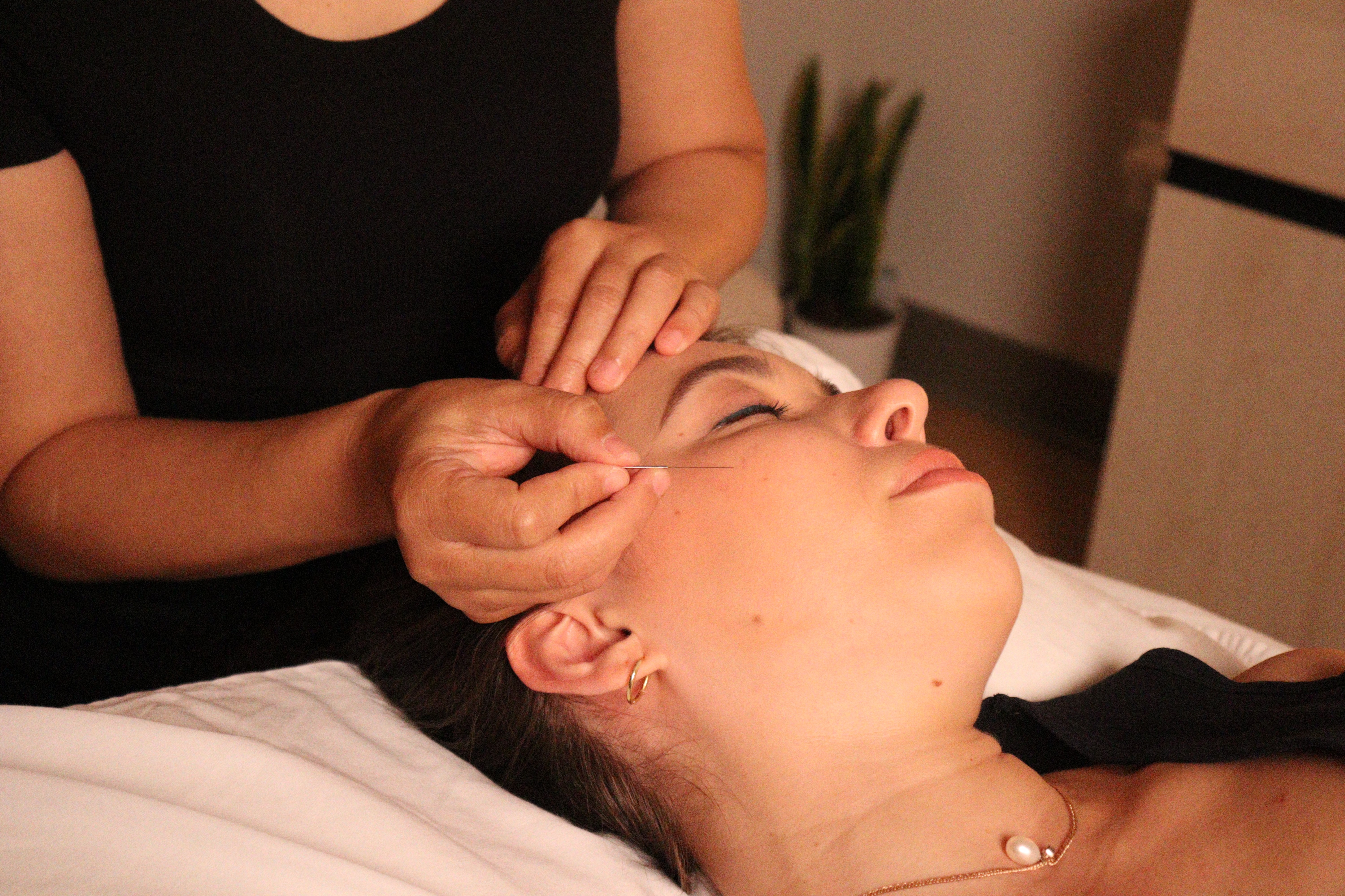 relaxed woman recieving facial acupuncture needles on her cheek