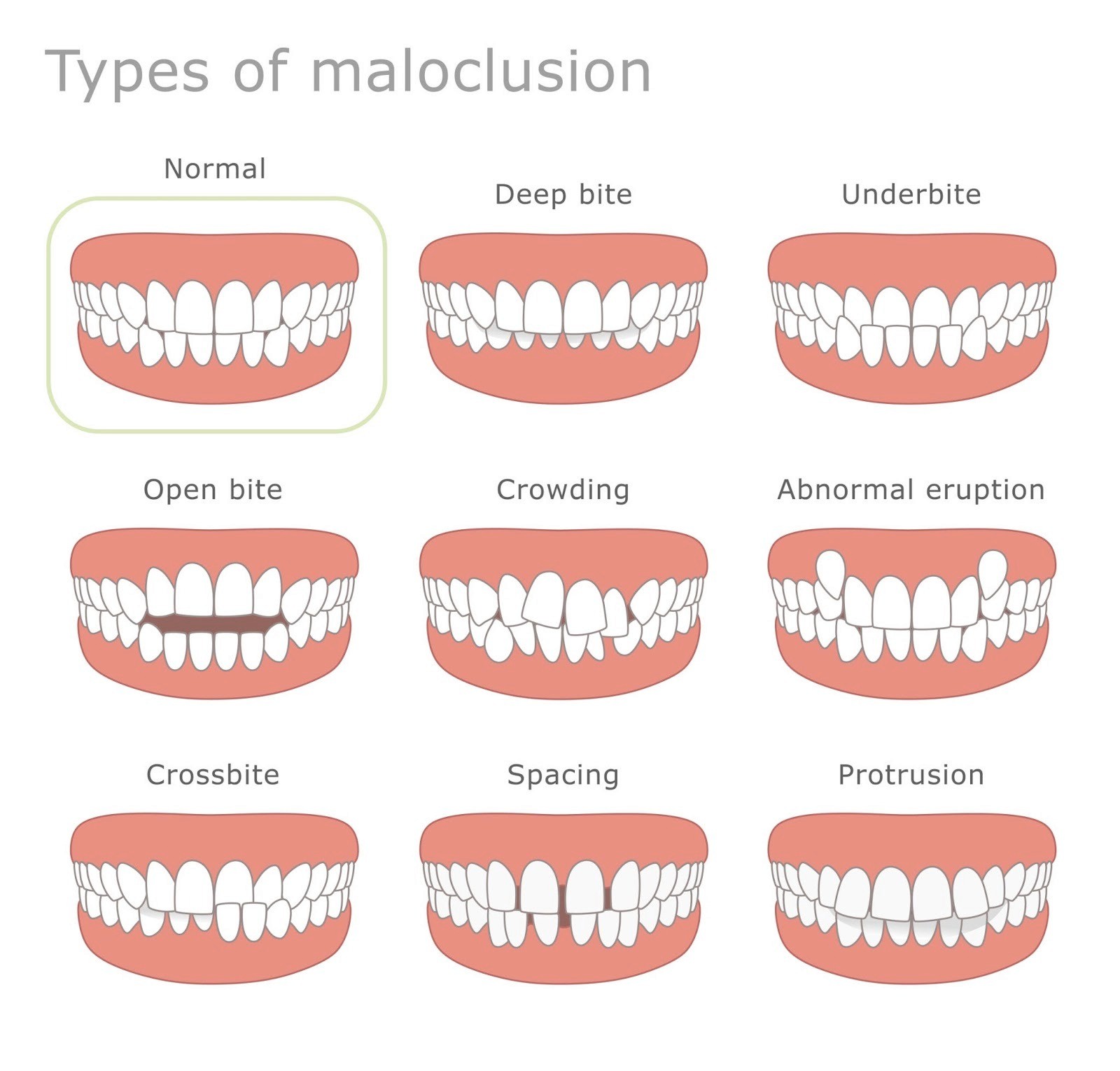 Image of a diagram showing different types of malocclusion (overbite, underbite, crossbite)
