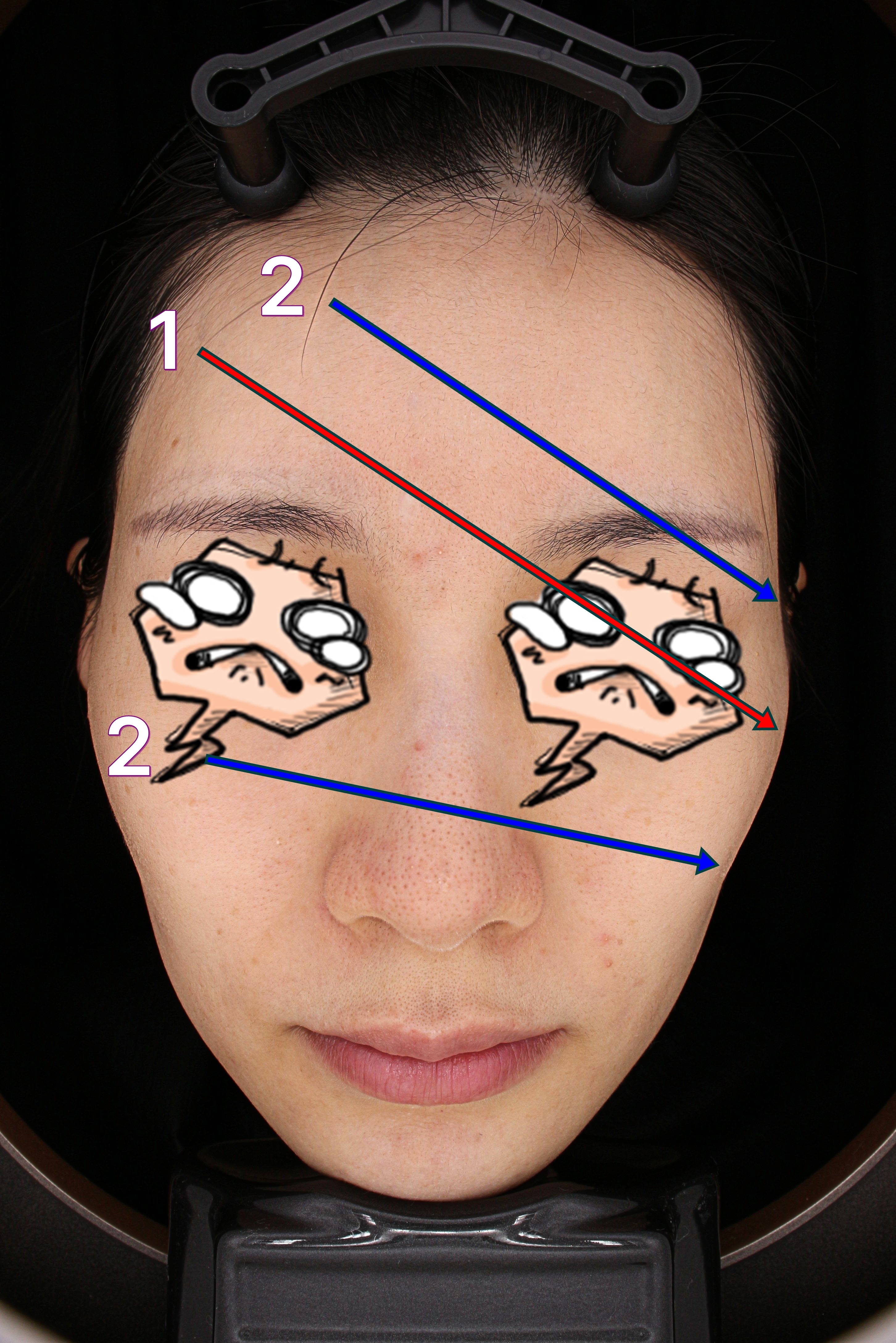 peanut-face-radiesse-temple
