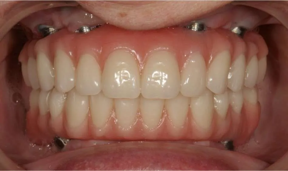 all-on-4 dental implants