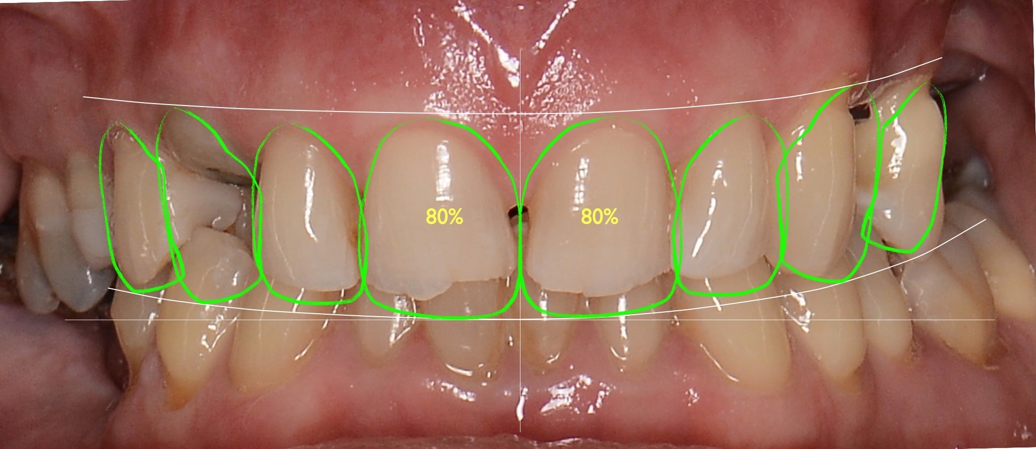 A close-up image of human teeth showing a detailed analysis with green contour lines outlining each tooth and numerical annotations indicating measurements or assessments, highlighting dental alignment and condition for cosmetic aesthetic dentistry A detailed X-ray image of a lower wisdom tooth displayed from multiple angles, highlighting its position and alignment within the jaw, with annotations and guidelines for dental analysis at Oakville Dental Implant Studio.