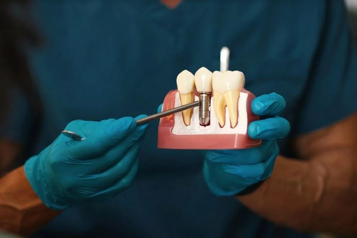 dental implant cost