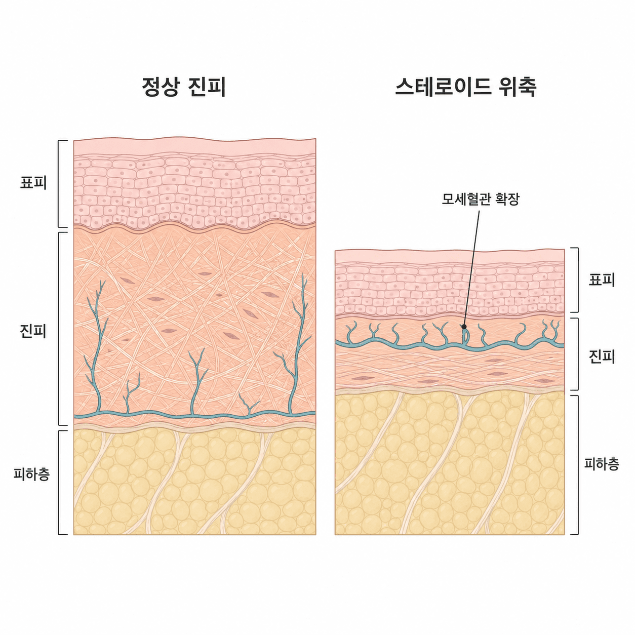 정상 진피(왼쪽)와 스테로이드 장기 사용 후 위축된 진피(오른쪽) 비교
