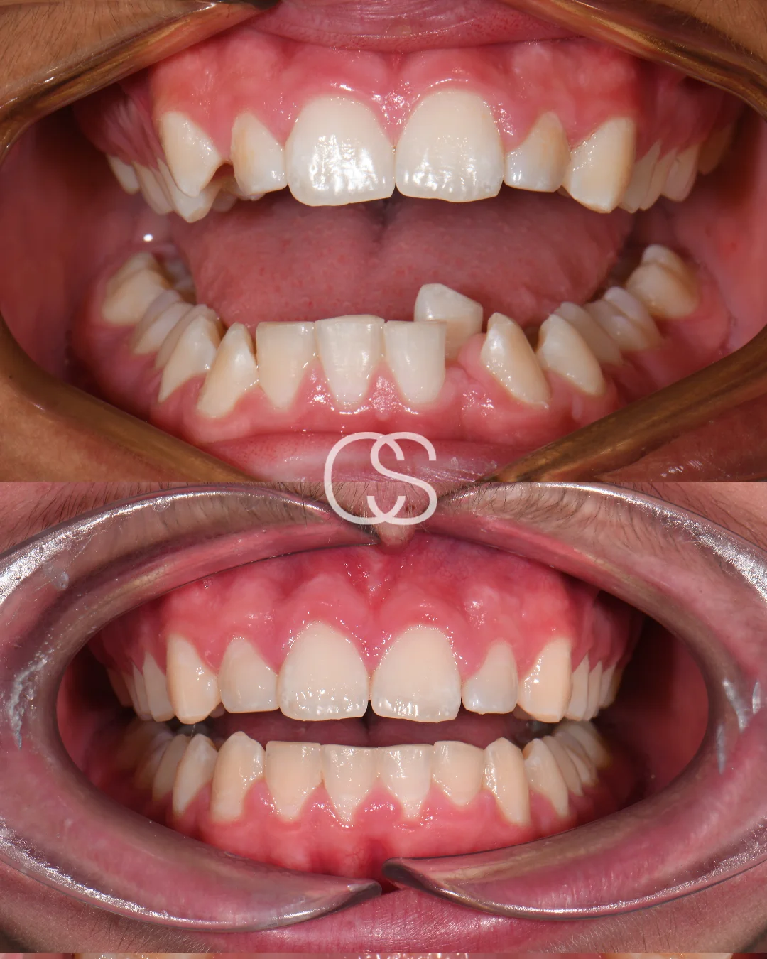 Before & After Braces at Colac Smiles, Colac