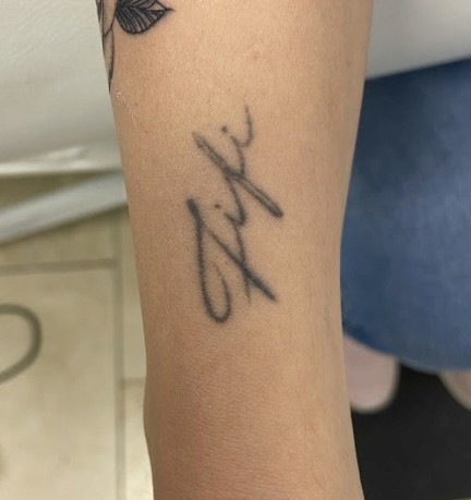 Imagem de antes e depois da remoção de tatuagem