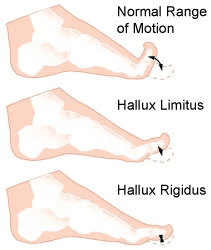 illustration of Hallux Limitus/Rigidus Surgery