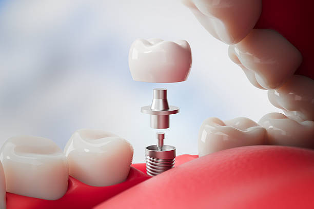 dental implants