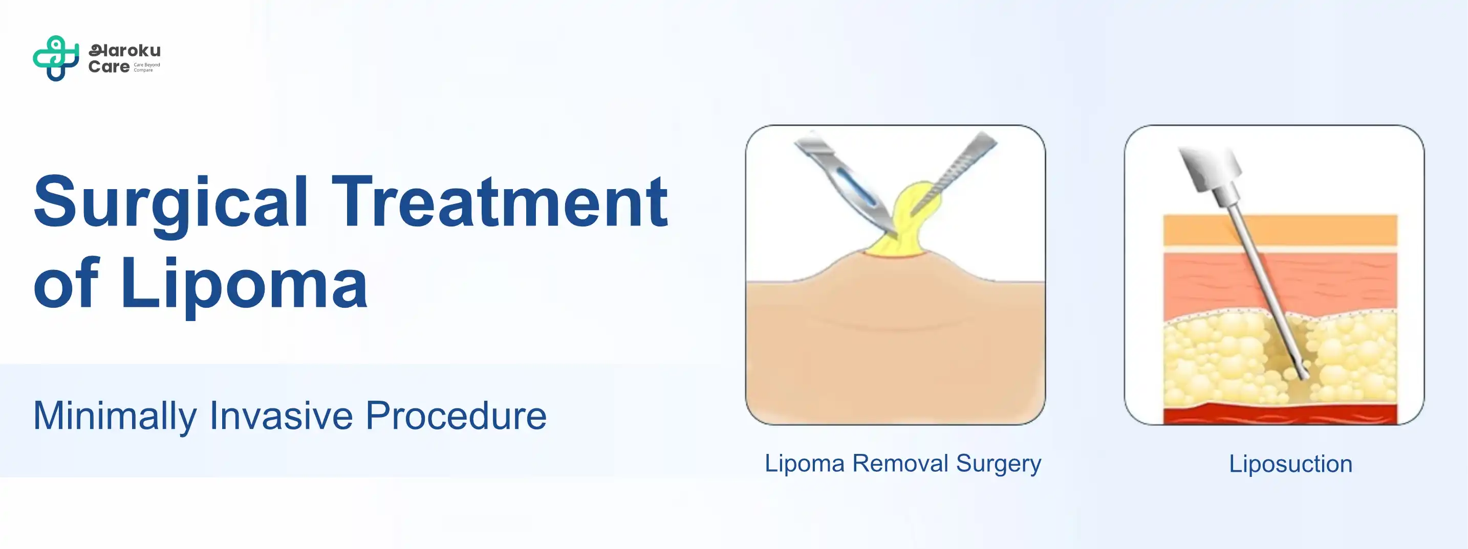 Gynecomastia before and after surgery results showing chest contour improvement
