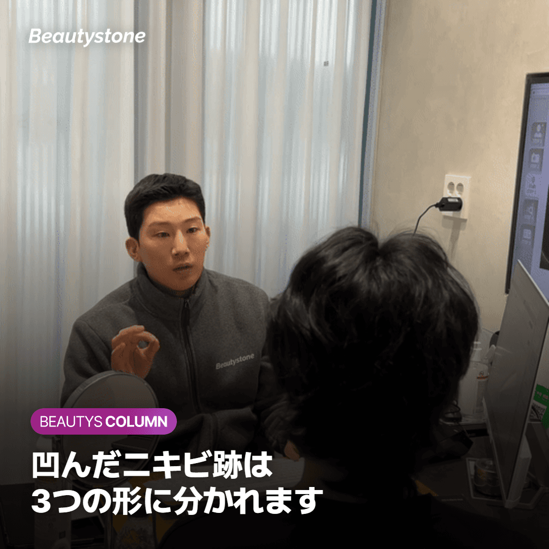 アイスピック型・ボックス型・ローリング型が異なる深さに位置するニキビ跡の図