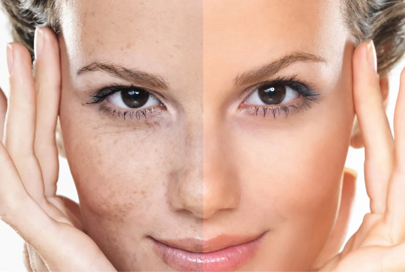 Expertos en "Tratamiento de melasma" en Terrassa, Barcelona. Heaven Clinics