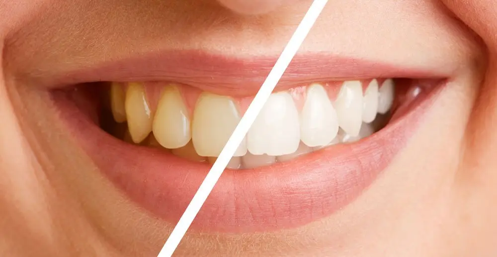 Como prevenir e tratar o tártaro