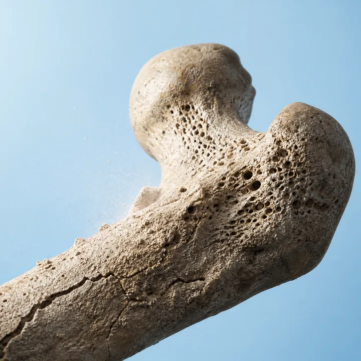 Weak, porous bone