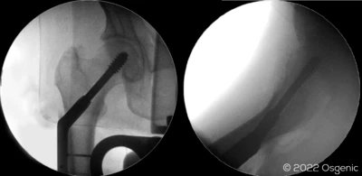 Sliding Hip Screw (DHS)