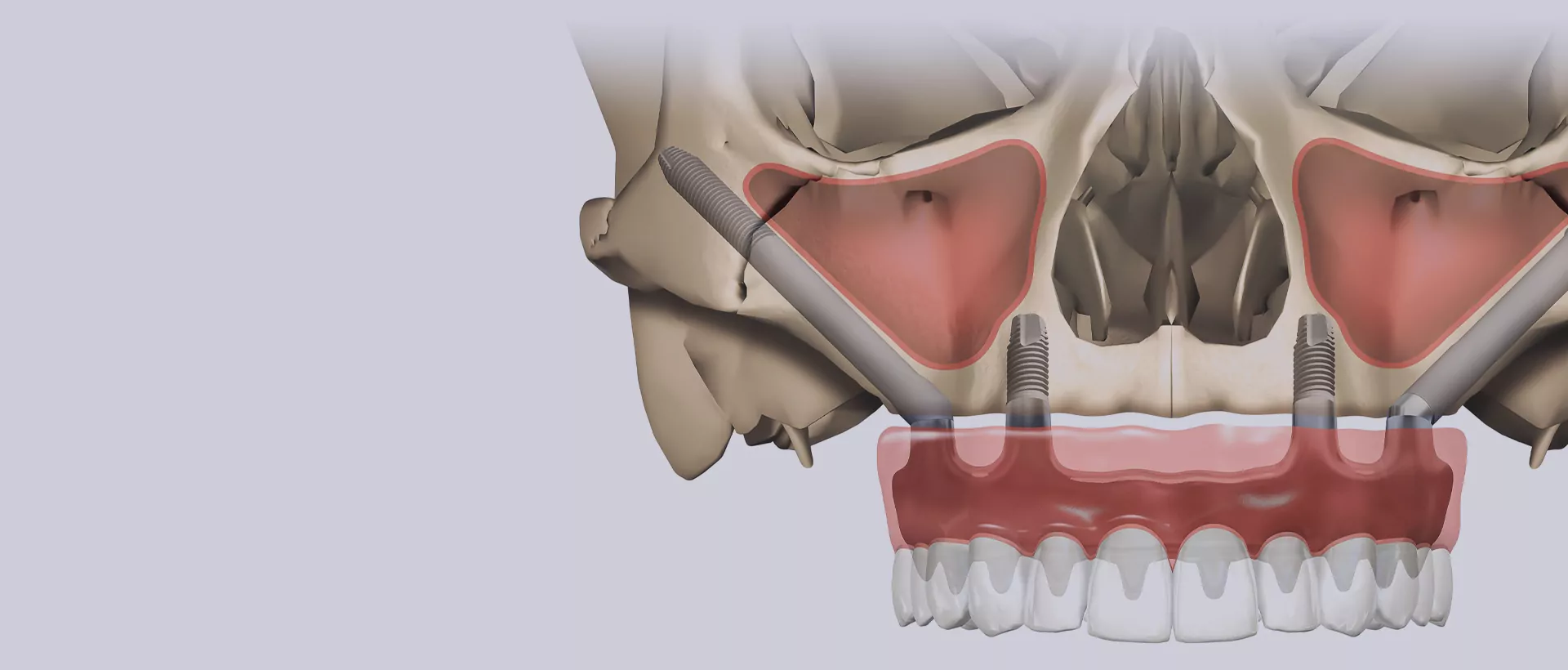 Zygomatic Implants