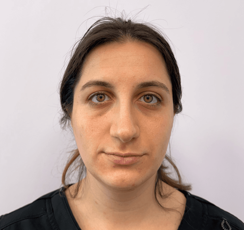 Organic Renewal Facial Before Oyster Bay