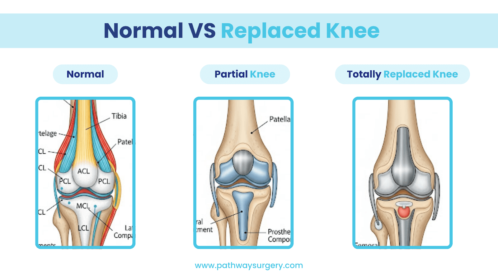 Comparing a healthy knee joint with a joint after a private knee replacement. 
