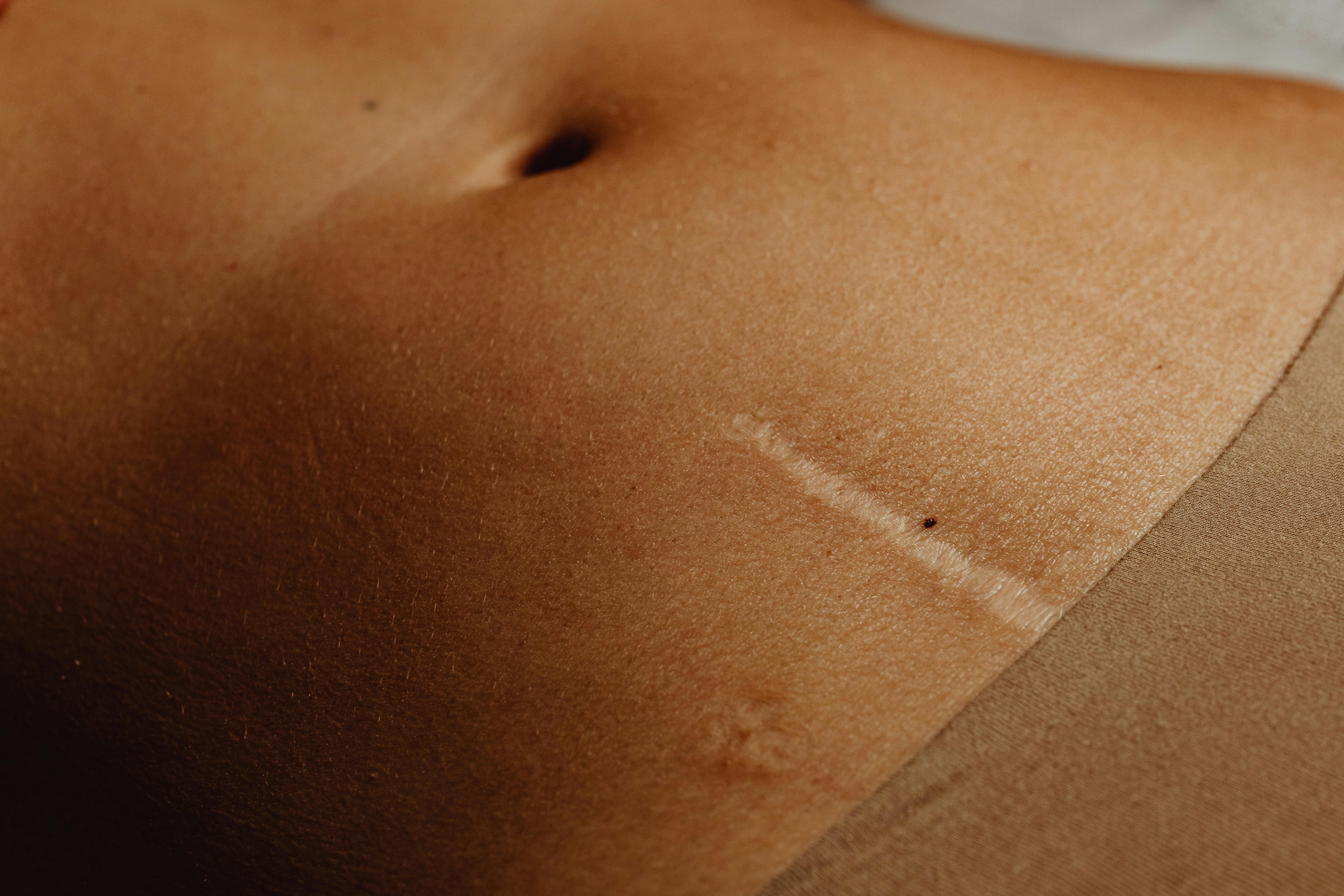 Close-up of skin texture illustrating scar treatment procedures