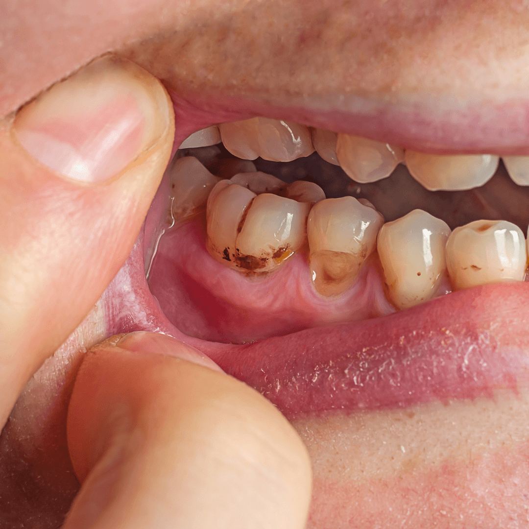 Prevent dental plaque