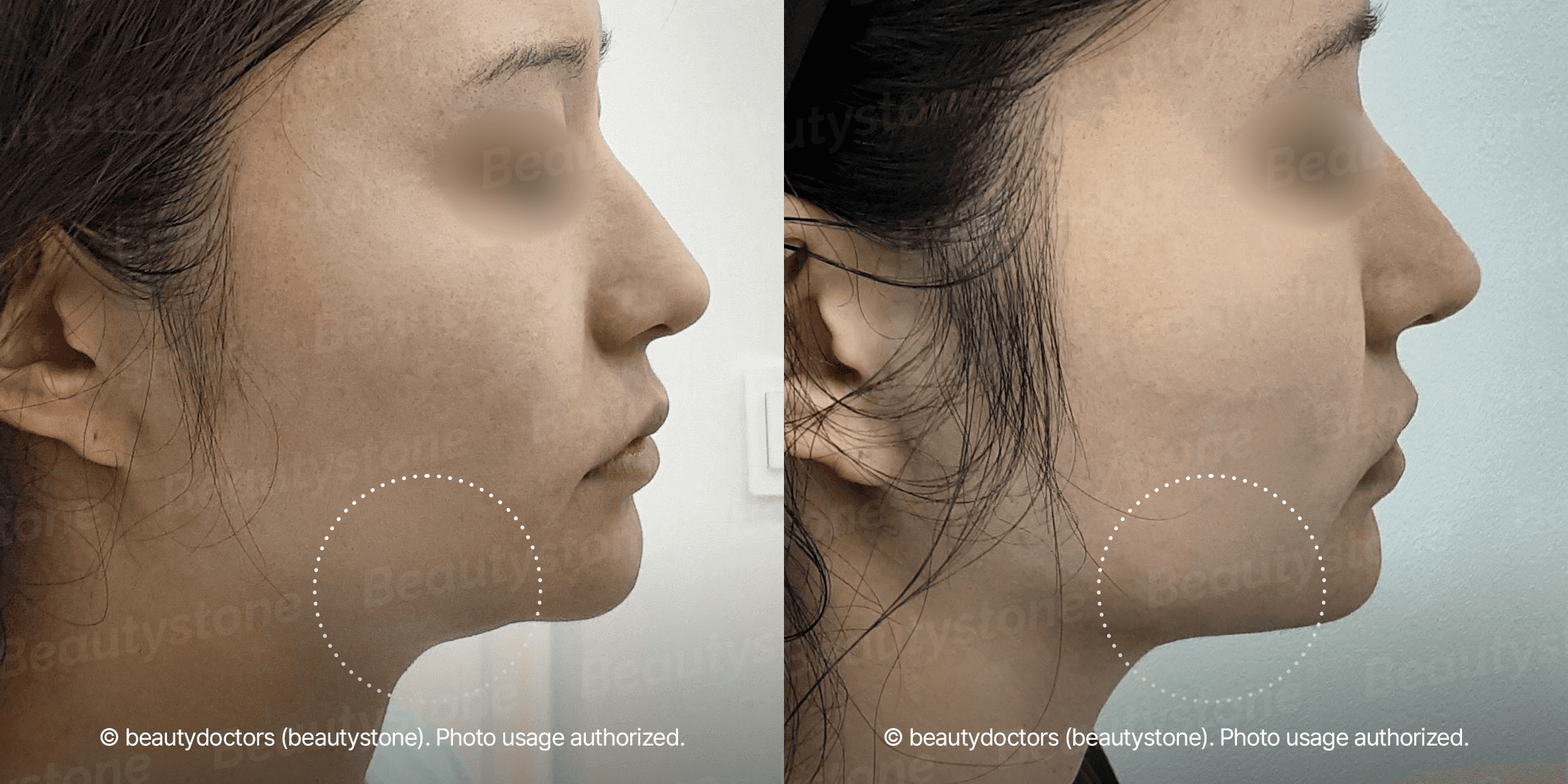 내 돈 100만 원, 울쎄라피에 쓸까 온다에 쓸까? 의사가 정해드림