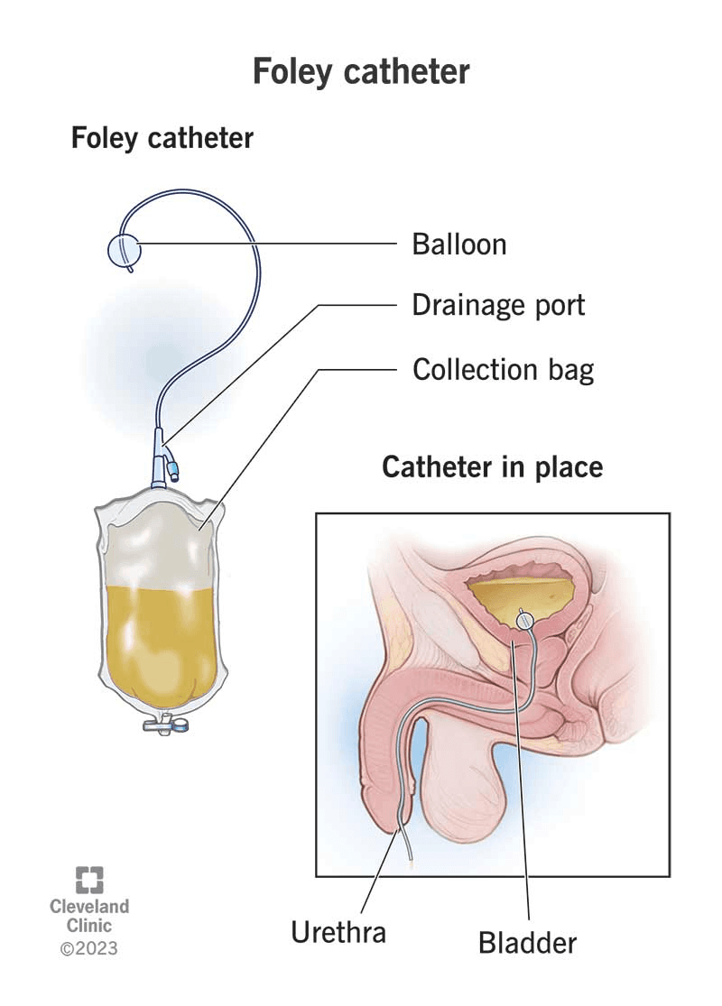 यहाँ एक Foley catheter की शारीरिक चित्रणा है, जिसमें मूत्राशय के अंदर सुरक्षित मूत्र निकासी के लिए फुलाया गया balloon दिखाया गया है, जो post-operative recovery के दौरान सहायक होता है।