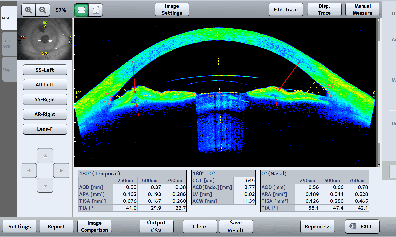 Casia 2 angle opening distance AOD - VisReed