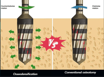 Osseodensification Vs Conventional osteotomy image