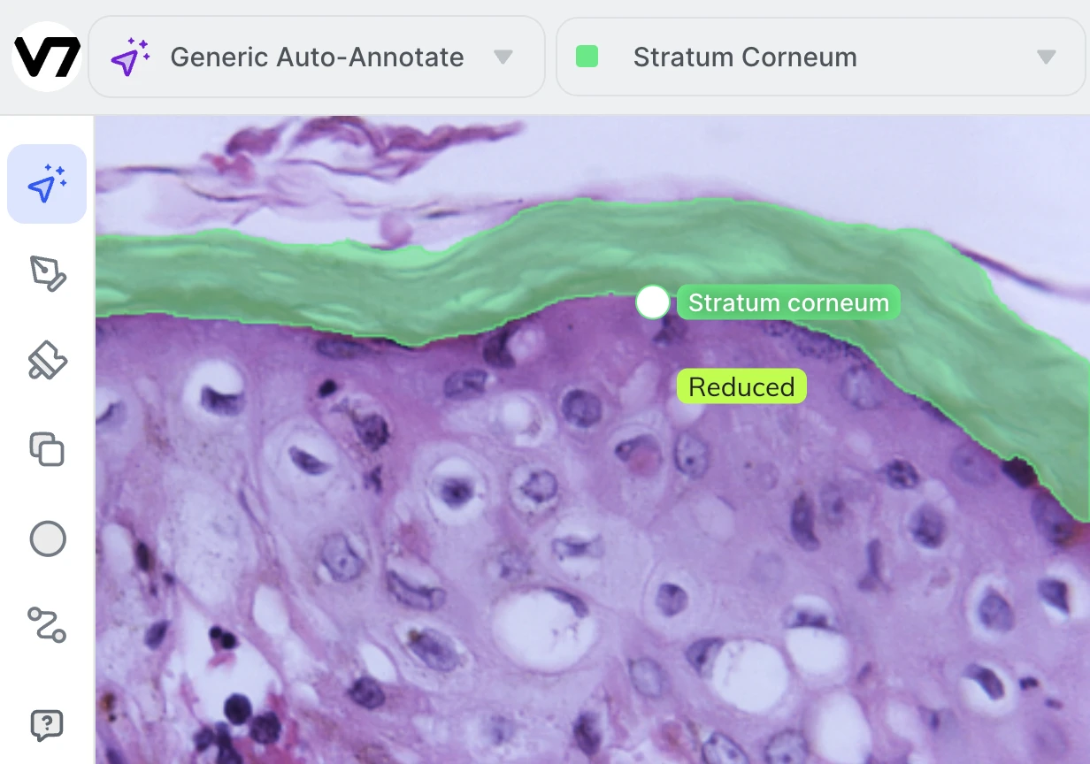 auto annotation corneum