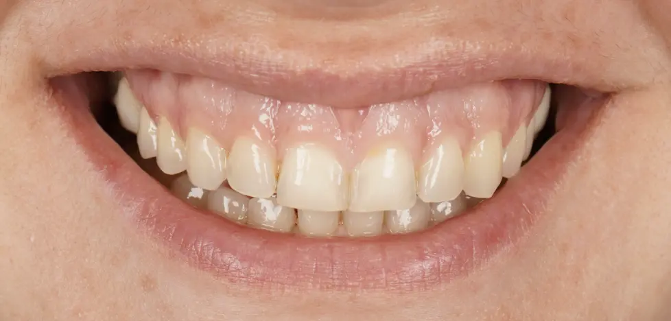 After ortho treatment