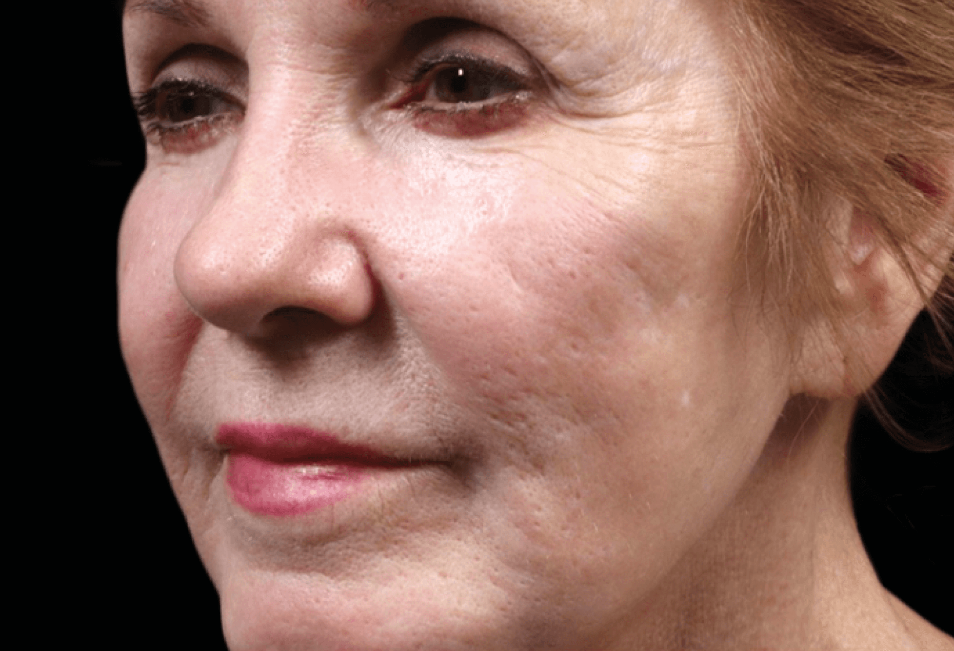 Exion RF Microneedling Before