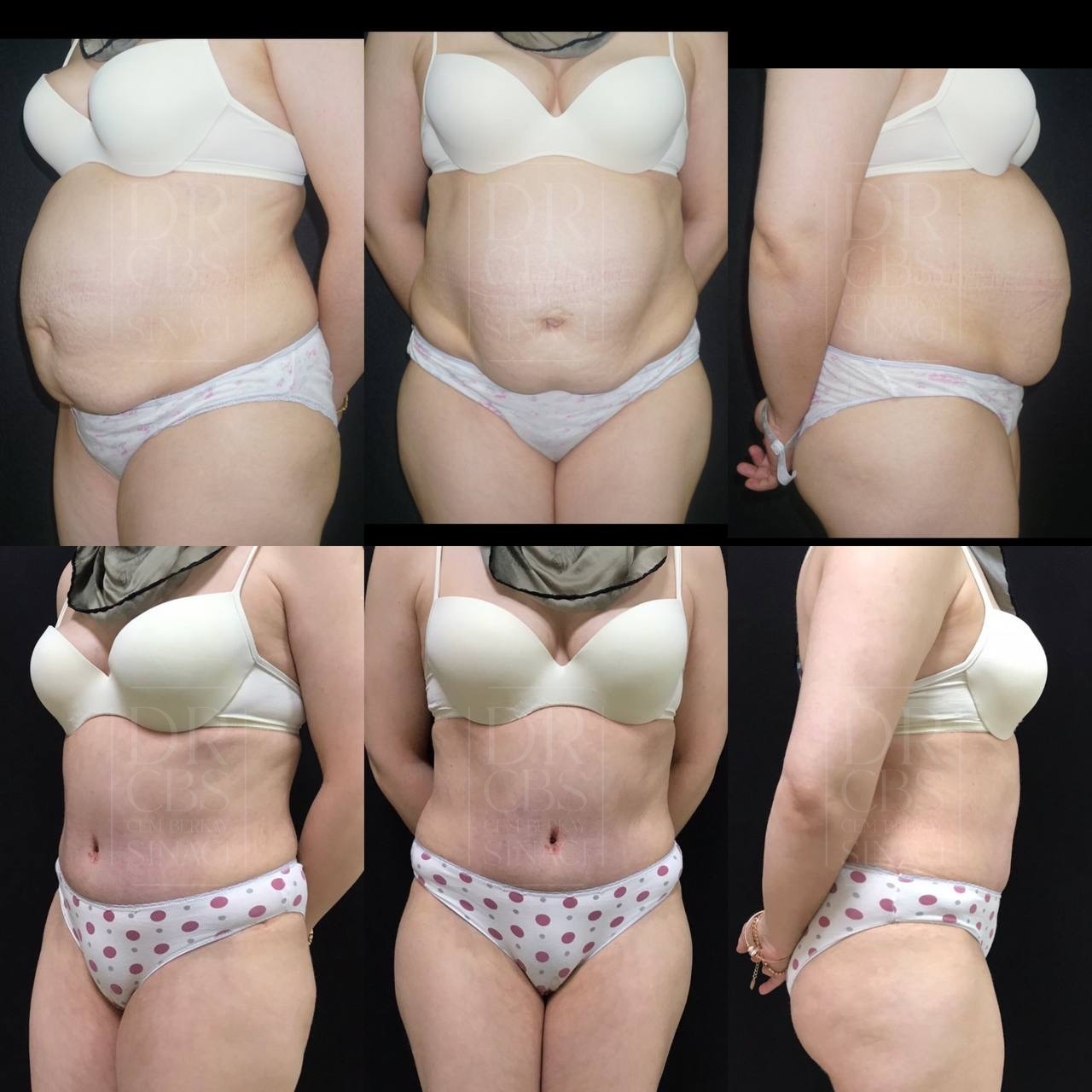 tummy tuck liposuction before after results 7 days after surgery