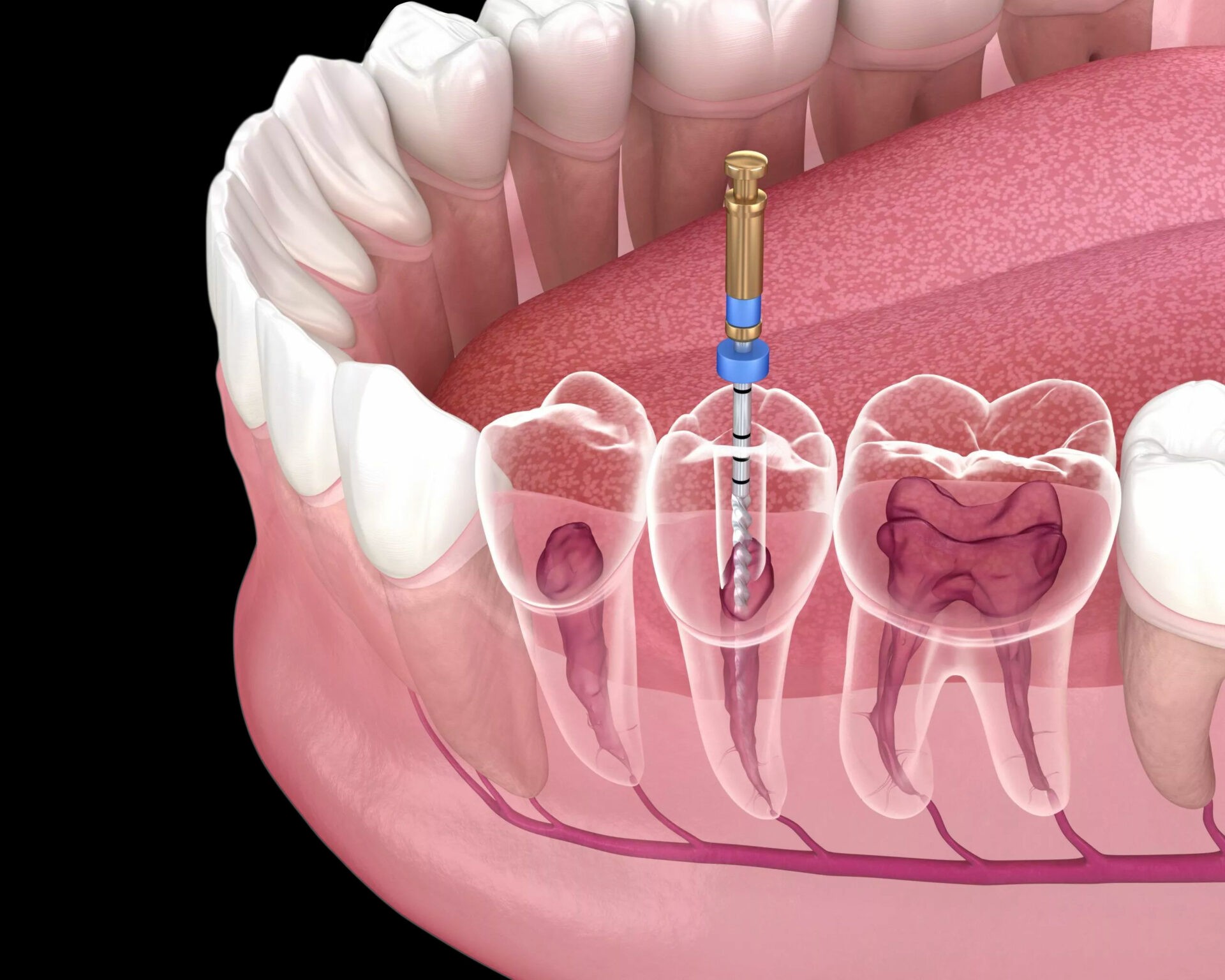 veneers